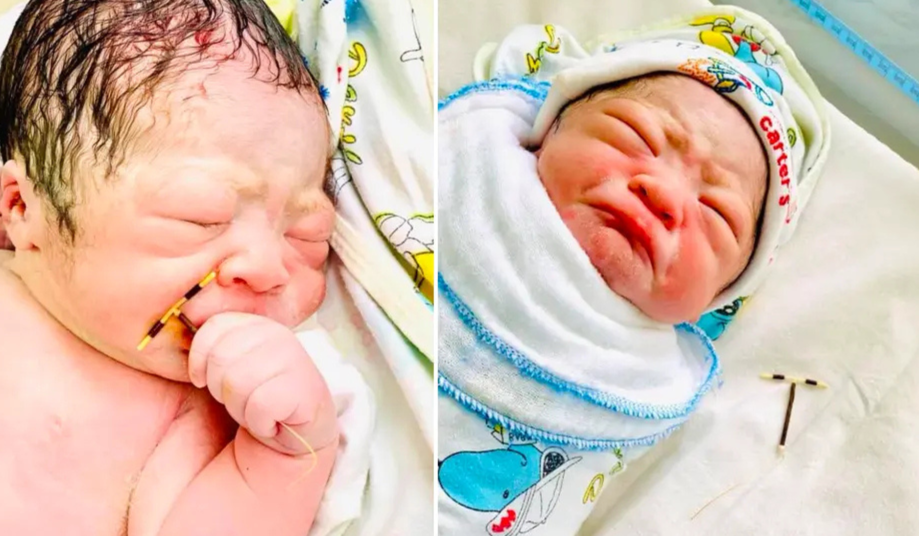 Brazilian Miracle Baby Born Holding IUD, Defying All Odds